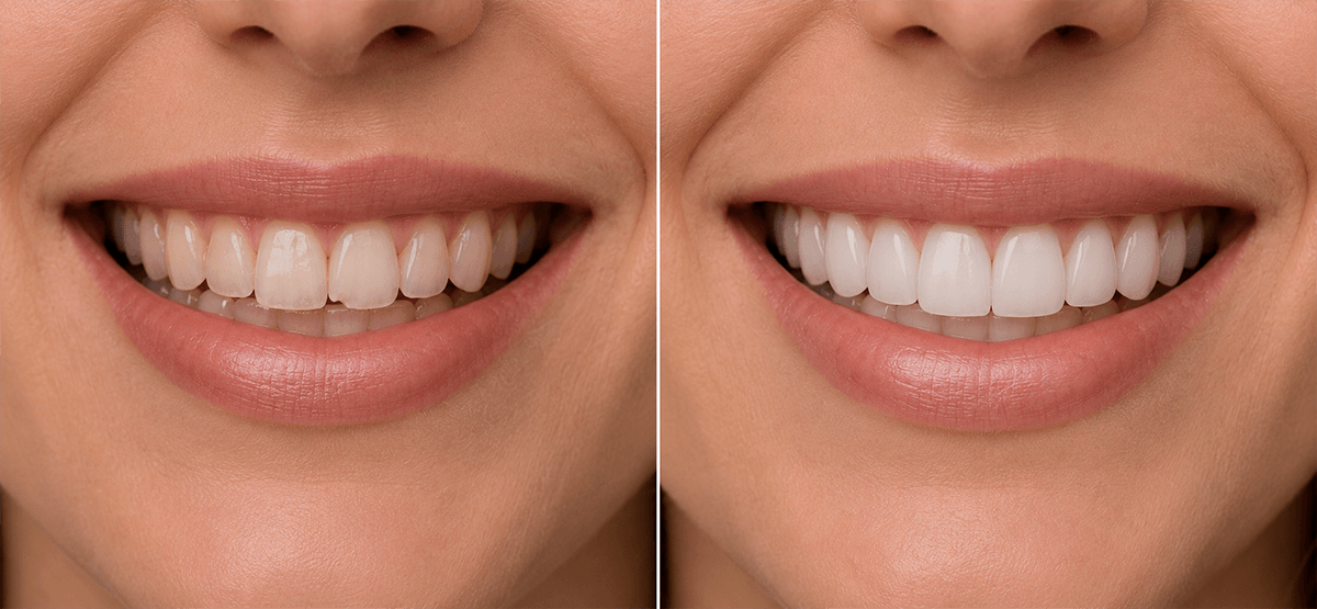 Comparação ilustrativa de sorriso antes e depois de alterações de forma, proporção e cor associadas ao planejamento de facetas cerâmicas