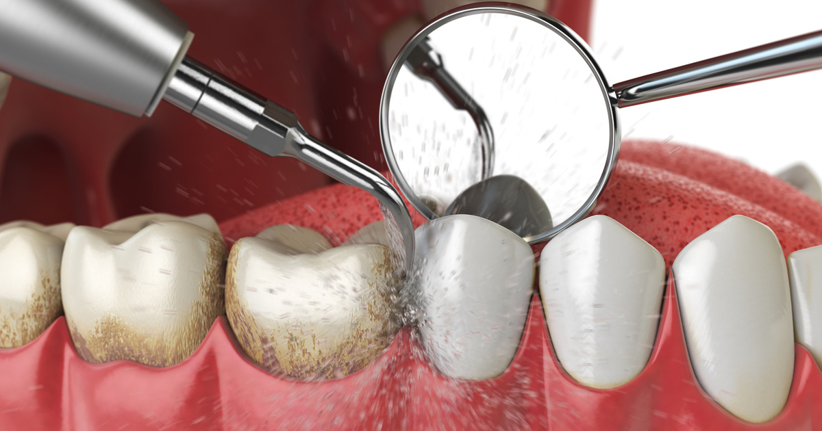 Instrumentação periodontal manual realizada com cureta
