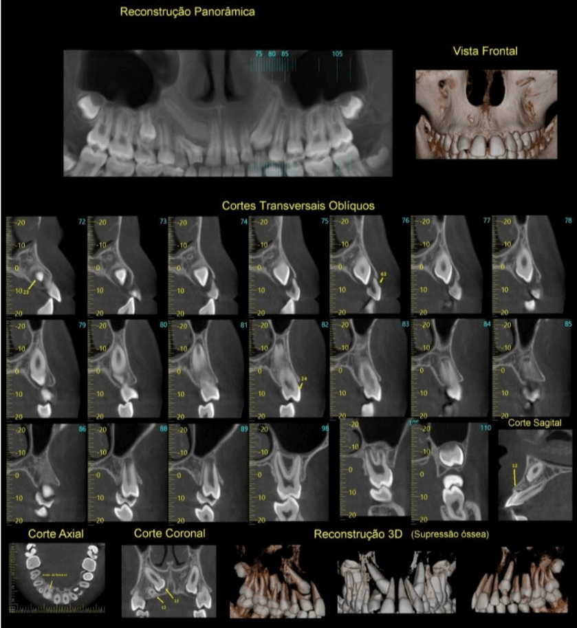 Tomografia da maxila para planejamento de implante dentário