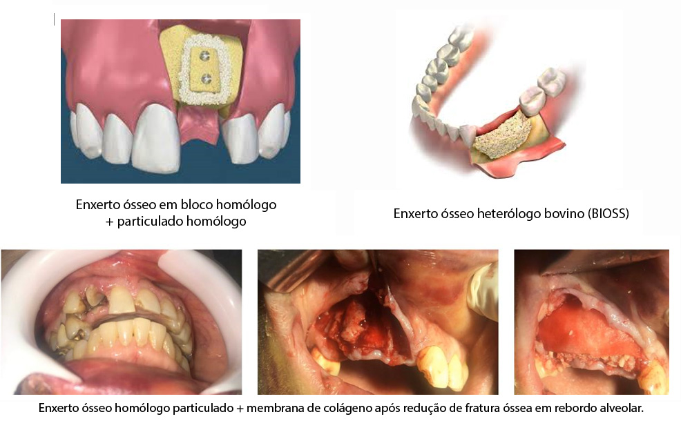 Tipos de enxerto ósseo utilizados em implantodontia