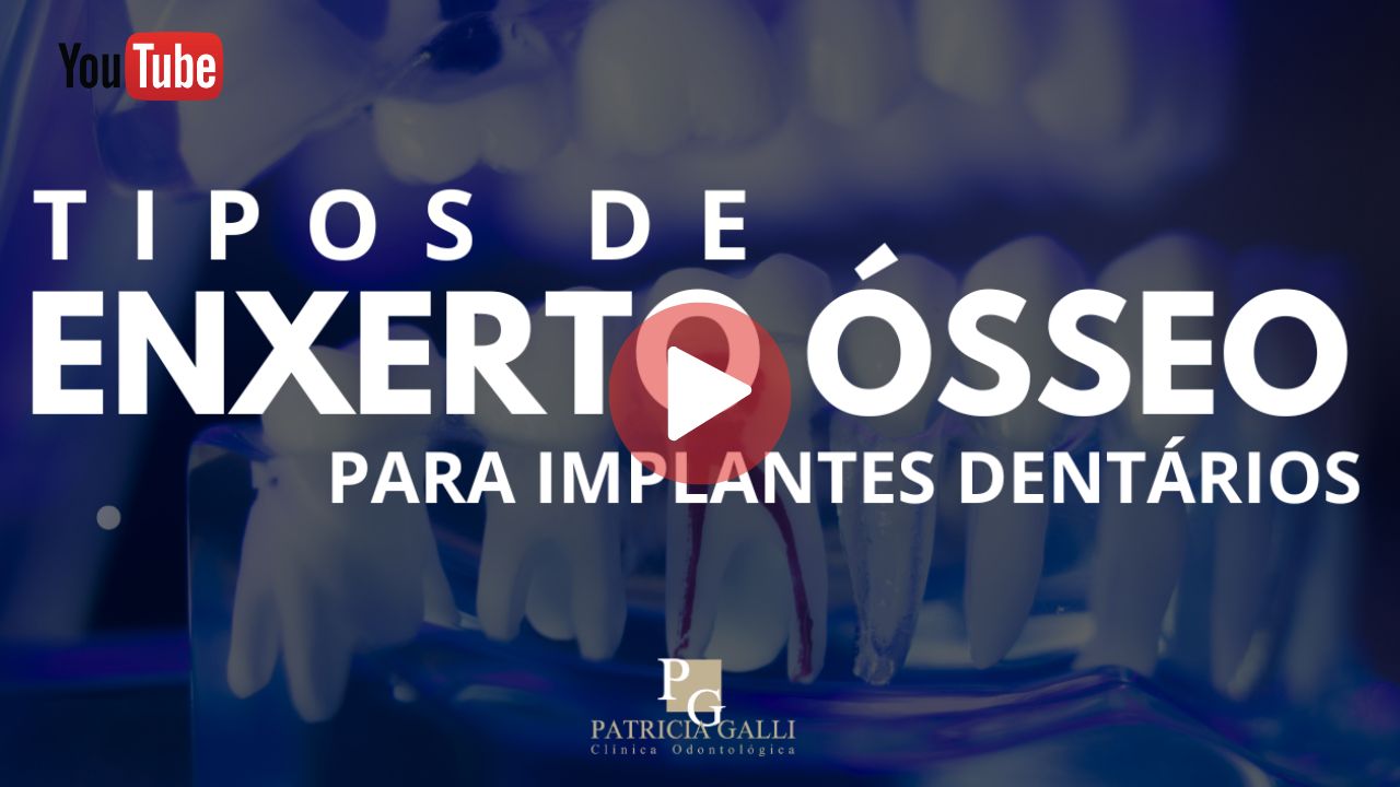 Vídeo sobre enxerto ósseo para implante dentário